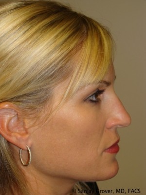 Rhinoplasty Before and After | Sanjay Grover MD FACS