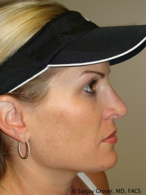 Rhinoplasty Before and After | Sanjay Grover MD FACS