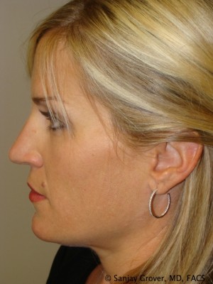 Rhinoplasty Before and After 34 | Sanjay Grover MD FACS