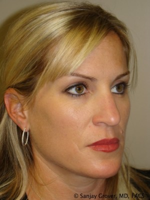 Rhinoplasty Before and After 34 | Grover Aesthetics