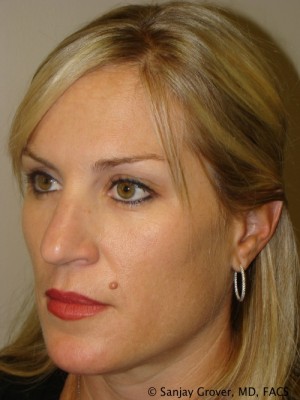 Rhinoplasty Before and After 34 | Grover Aesthetics