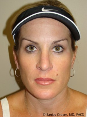 Rhinoplasty Before and After 34 | Grover Aesthetics