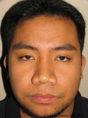Rhinoplasty Before and After | Grover Aesthetics
