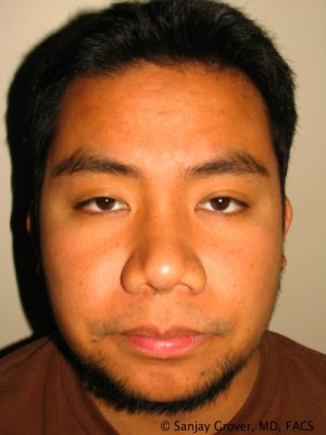 Rhinoplasty Before and After | Grover Aesthetics