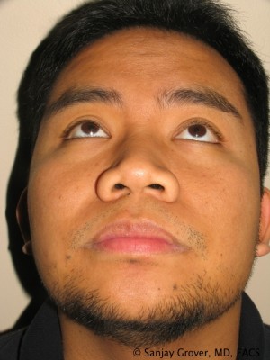 Rhinoplasty Before and After 35 | Grover Aesthetics