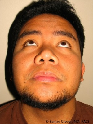 Rhinoplasty Before and After 35 | Grover Aesthetics