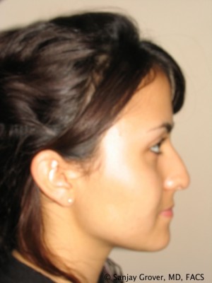 Rhinoplasty Before and After 38 | Sanjay Grover MD FACS