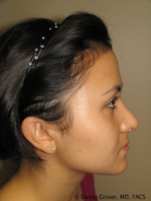 Rhinoplasty Before and After | Sanjay Grover MD FACS