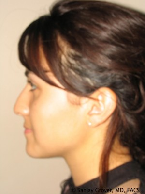 Rhinoplasty Before and After 36 | Grover Aesthetics