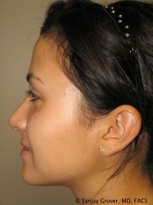Rhinoplasty Before and After 36 | Grover Aesthetics