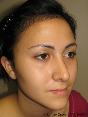 Rhinoplasty Before and After 36 | Grover Aesthetics