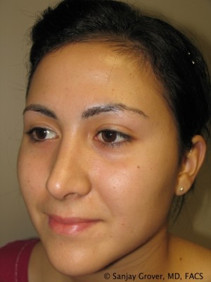 Rhinoplasty Before and After 36 | Grover Aesthetics