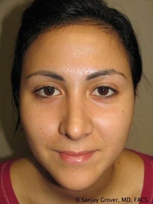 Rhinoplasty Before and After 36 | Sanjay Grover MD FACS