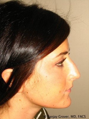 Rhinoplasty Before and After | Sanjay Grover MD FACS