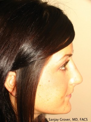 Rhinoplasty Before and After | Sanjay Grover MD FACS