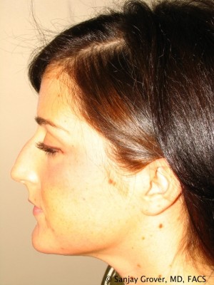 Rhinoplasty Before and After 37 | Grover Aesthetics