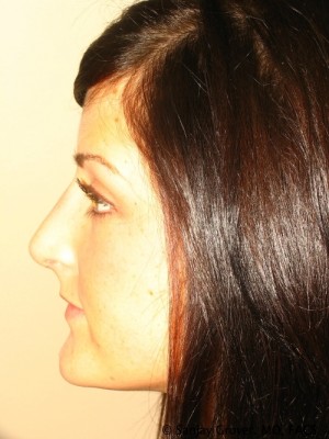 Rhinoplasty Before and After 37 | Grover Aesthetics