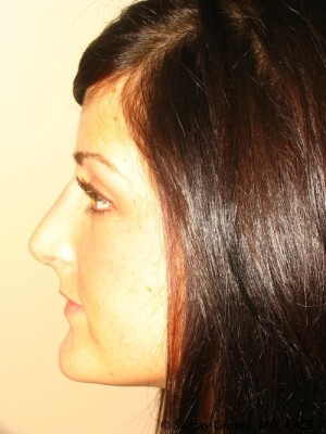 Rhinoplasty Before and After 37 | Sanjay Grover MD FACS