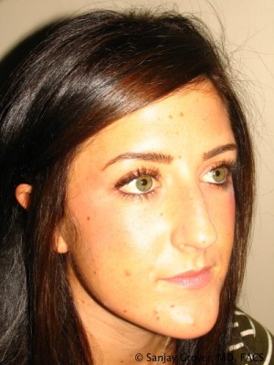 Rhinoplasty Before and After 37 | Grover Aesthetics