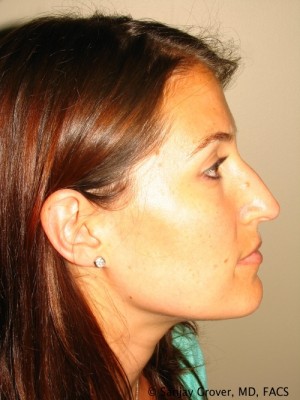 Rhinoplasty Before and After 38 | Sanjay Grover MD FACS