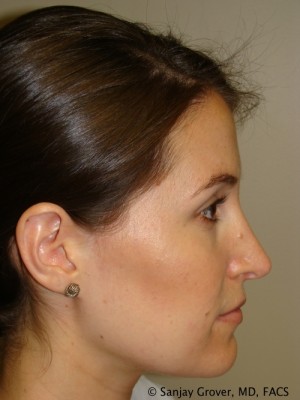 Rhinoplasty Before and After 38 | Sanjay Grover MD FACS