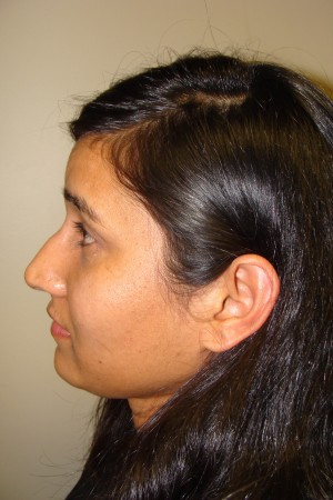 Rhinoplasty Before and After 38 | Sanjay Grover MD FACS