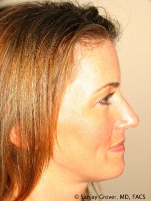 Rhinoplasty Before and After | Grover Aesthetics