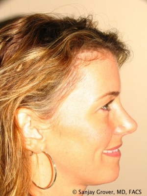 Rhinoplasty Before and After 39 | Sanjay Grover MD FACS