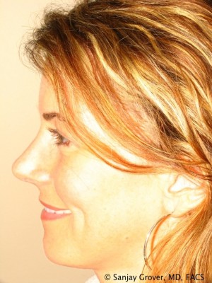 Rhinoplasty Before and After 39 | Grover Aesthetics