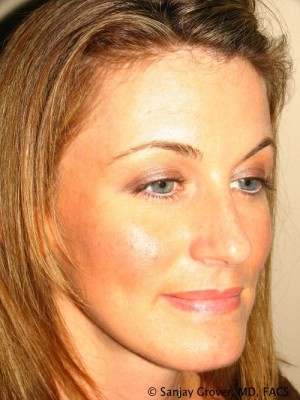 Rhinoplasty Before and After 39 | Grover Aesthetics