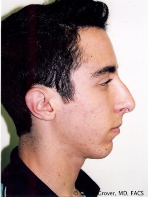 Rhinoplasty Before and After 16 | Sanjay Grover MD FACS