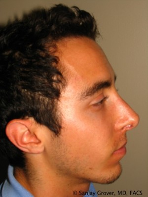 Rhinoplasty Before and After | Grover Aesthetics