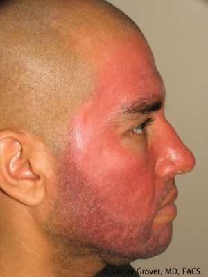 Rhinoplasty Before and After | Grover Aesthetics