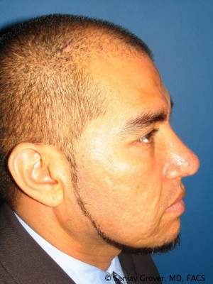 Rhinoplasty Before and After | Grover Aesthetics