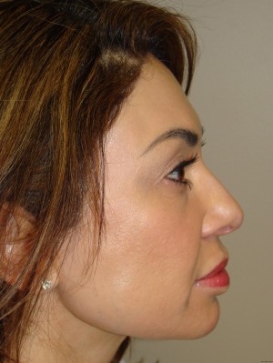 Rhinoplasty Before and After | Grover Aesthetics