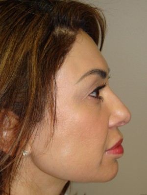 Rhinoplasty Before and After 15 | Sanjay Grover MD FACS