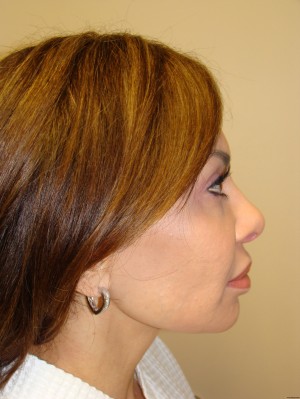 Rhinoplasty Before and After | Grover Aesthetics