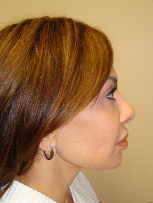 Rhinoplasty Before and After | Sanjay Grover MD FACS