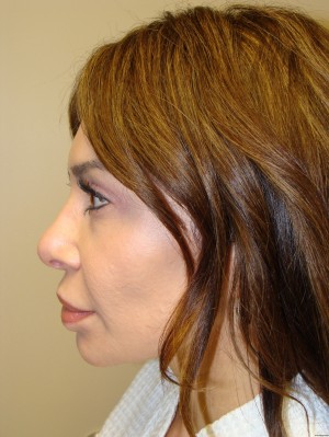 Rhinoplasty Before and After 42 | Grover Aesthetics