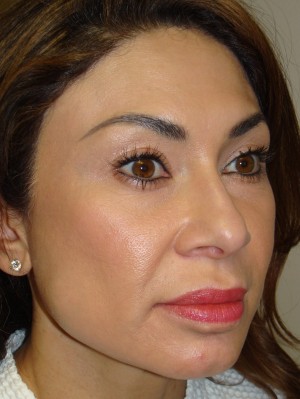Rhinoplasty Before and After 42 | Grover Aesthetics