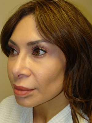 Rhinoplasty Before and After 42 | Grover Aesthetics