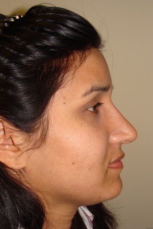 Rhinoplasty Before and After | Grover Aesthetics