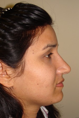 Rhinoplasty Before and After | Sanjay Grover MD FACS