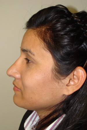 Rhinoplasty Before and After 43 | Sanjay Grover MD FACS