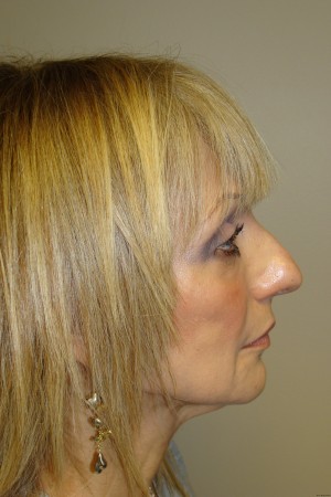 Rhinoplasty Before and After | Sanjay Grover MD FACS