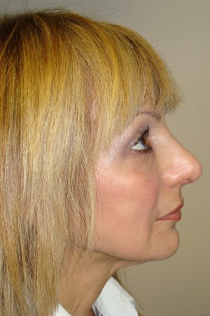 Rhinoplasty Before and After | Sanjay Grover MD FACS