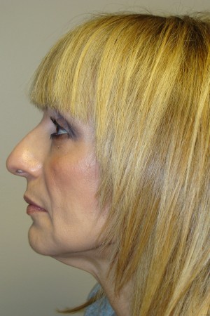 Rhinoplasty Before and After 44 | Grover Aesthetics