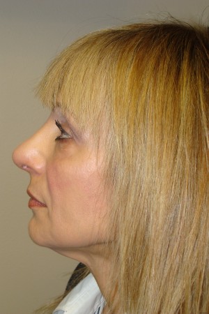 Rhinoplasty Before and After 44 | Sanjay Grover MD FACS