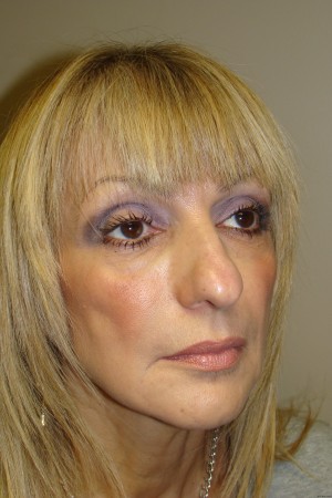 Rhinoplasty Before and After 44 | Grover Aesthetics