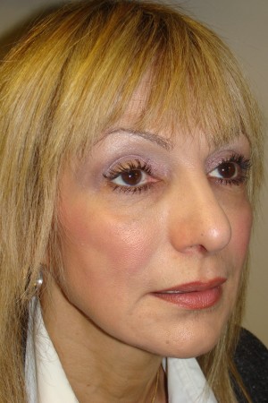 Rhinoplasty Before and After 44 | Grover Aesthetics